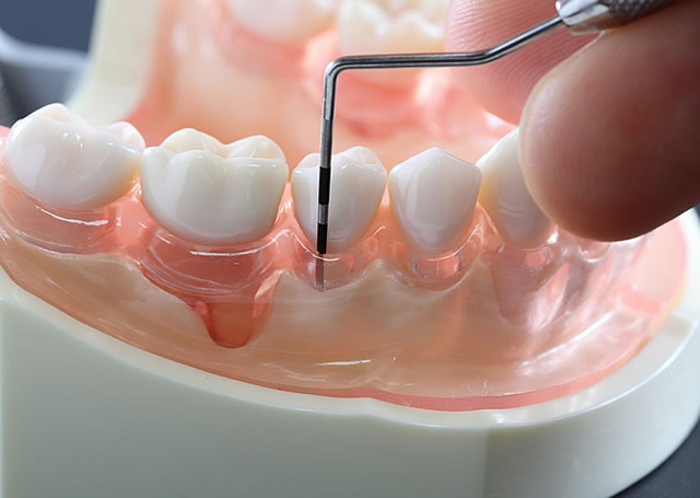 歯周病の検査